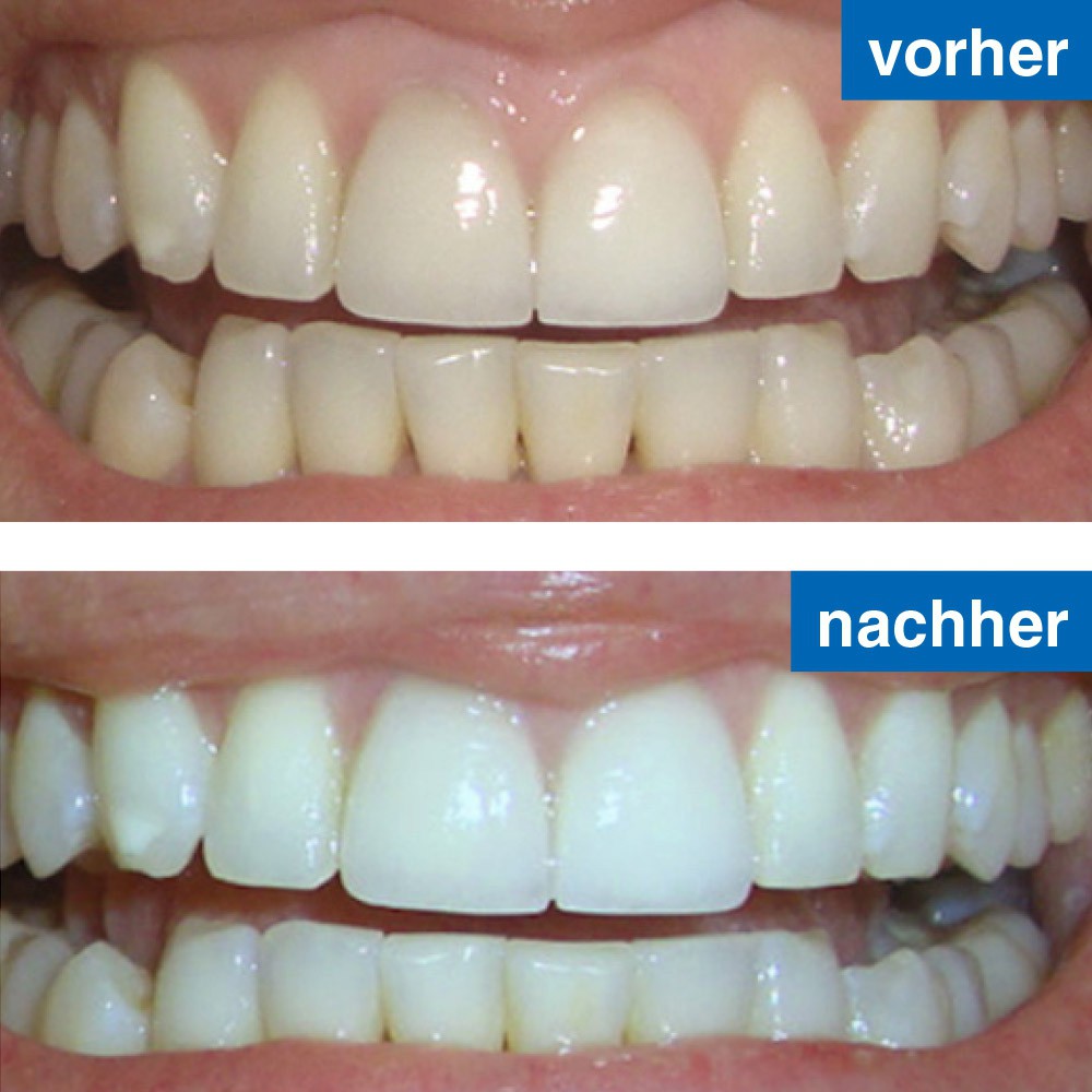 Zahnaufhellung Vorher/nachher-Bild